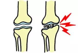 突发关节肿痛 当心痛风作祟-第1张图片-中国中医健康网