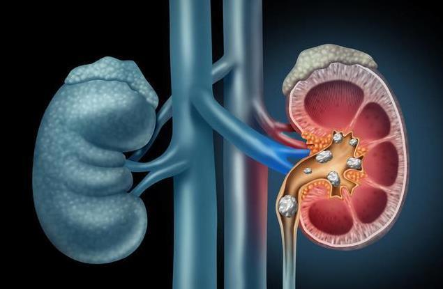 科学用药，警惕儿童药物性肾结石-第1张图片-中国中医健康网