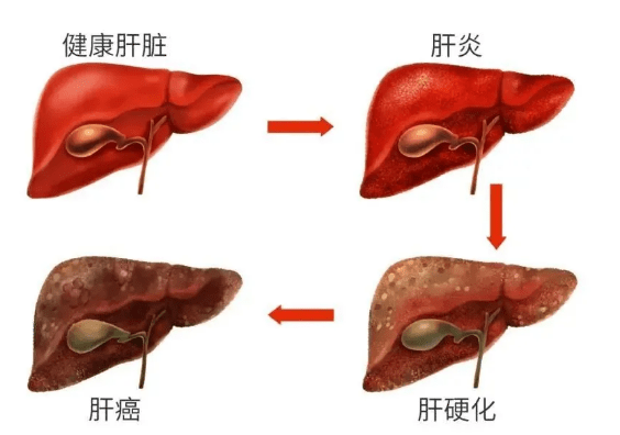 认清病毒性肝炎真面目 规范治疗阻断肝炎转癌“三部曲”-第1张图片-中国中医健康网