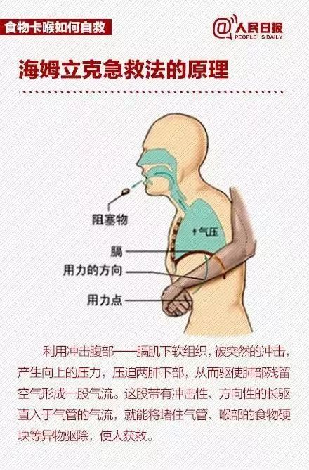 打通冠脉重度狭窄 挽救临危患者生命-第1张图片-中国中医健康网